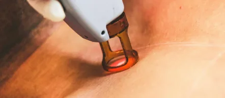 Laser Treatments
