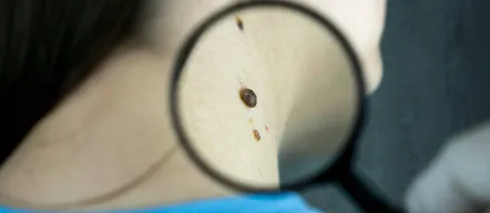 Skin Tag and Lesion Removal